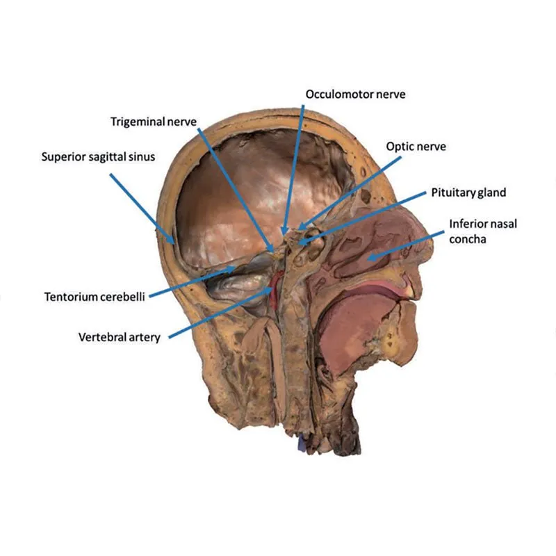 3D Printed Sagittal Section of Head and Neck with Infratemporal Fossa and Carotid Sheath Dissection