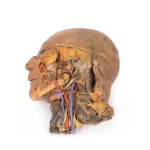 3D Printed Sagittal Section of Head and Neck with Infratemporal Fossa and Carotid Sheath Dissection